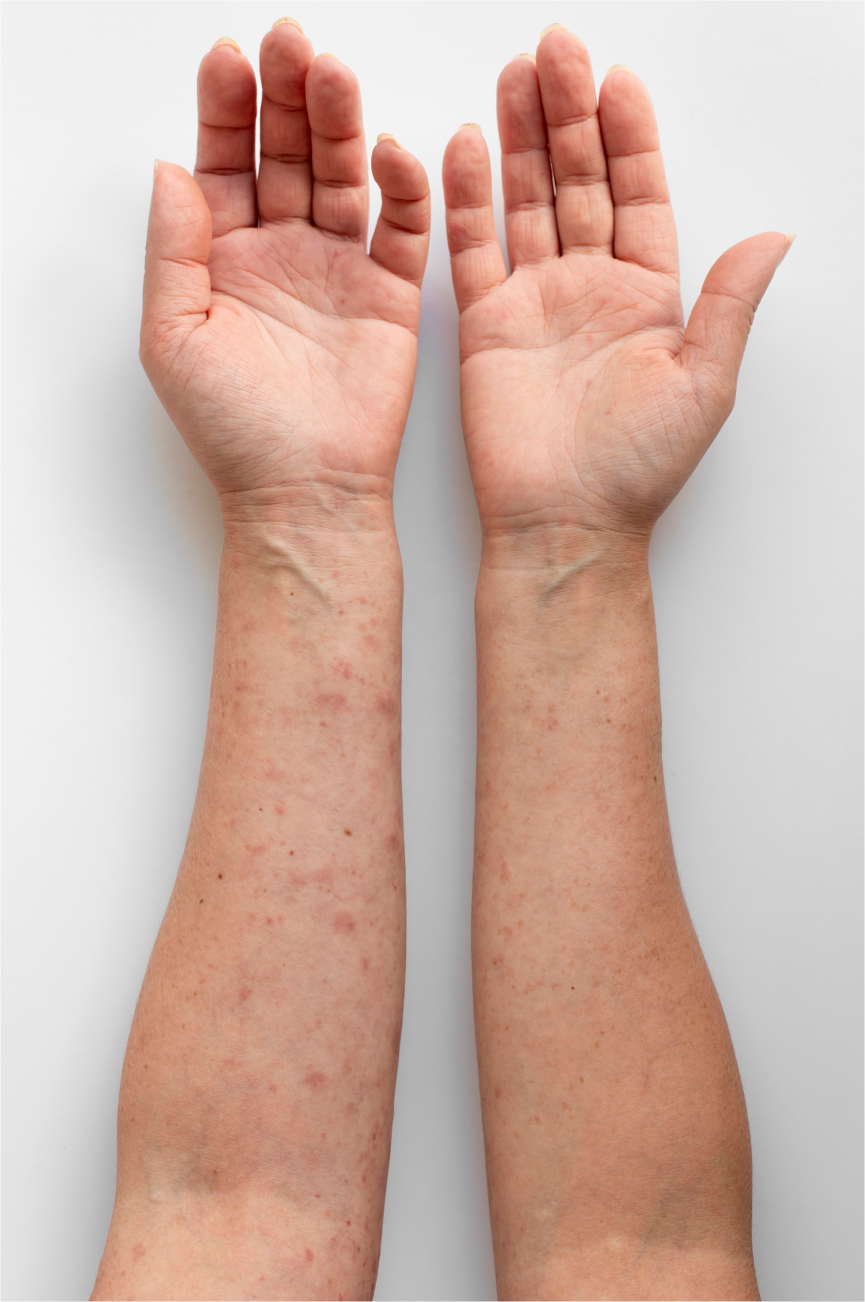 крем за псориазис, крем за дерматит и крем за екзема